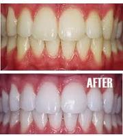 Laser Teeth Whitening service